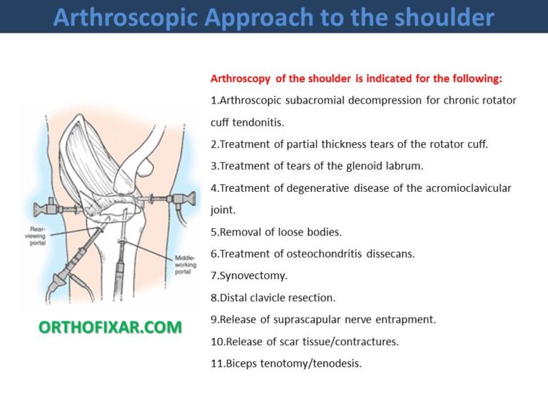 Arthroscopic Approach to the shoulder
