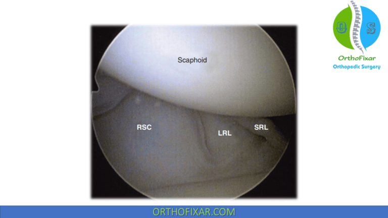 Volar Ganglion Cyst In The Wrist | OrthoFixar 2024