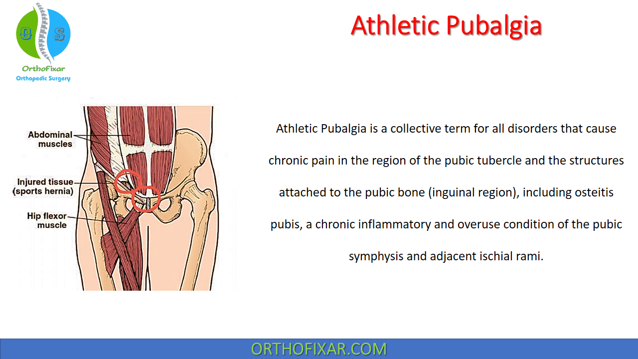 Athletic Pubalgia (Sports Hernia)