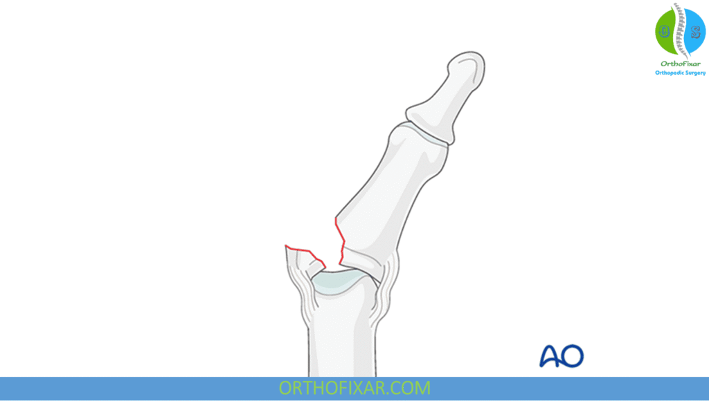 Avulsion Fracture: Causes, Symptoms, Treatment & Recovery 4 Avulsion Fracture finger