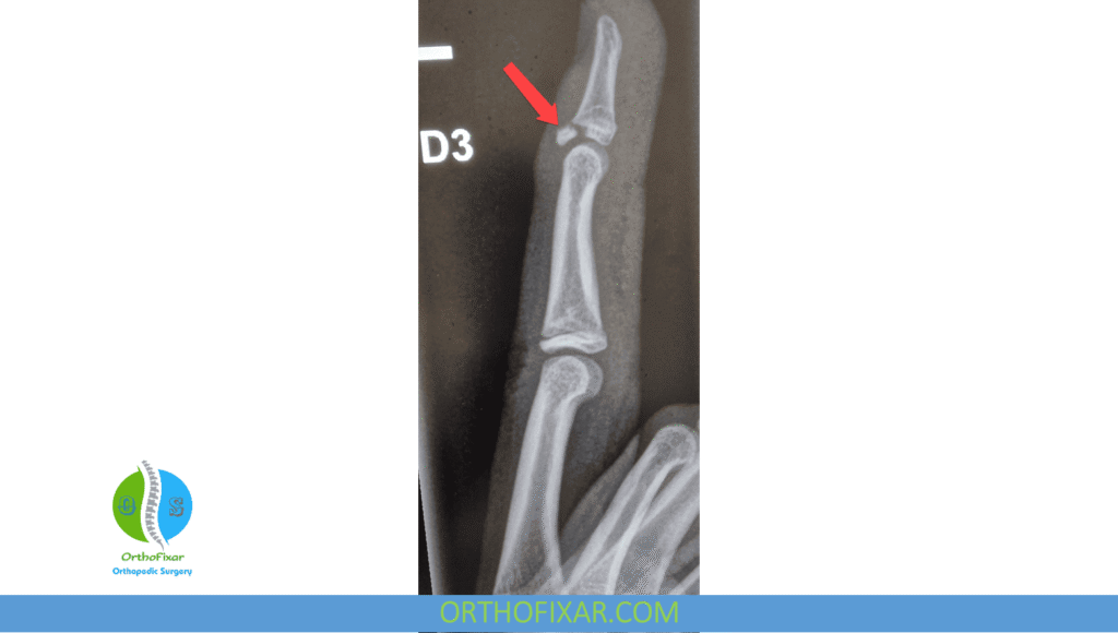Avulsion Fracture: Causes, Symptoms, Treatment & Recovery 5 Avulsion Fracture finger xray