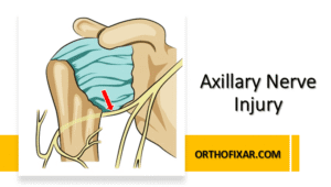 Axillary Nerve Injury
