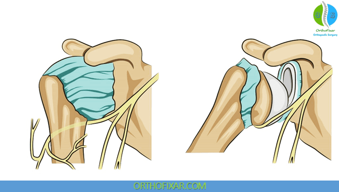 Axillary Nerve Injury 2 Axillary Nerve Injury with shoulder dislocation