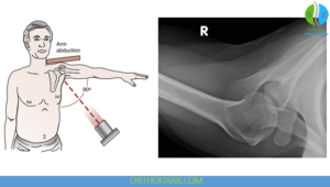 Shoulder X ray Views