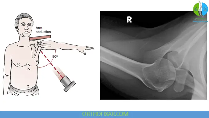 Shoulder X-ray Views 2 Axillary lateral view
