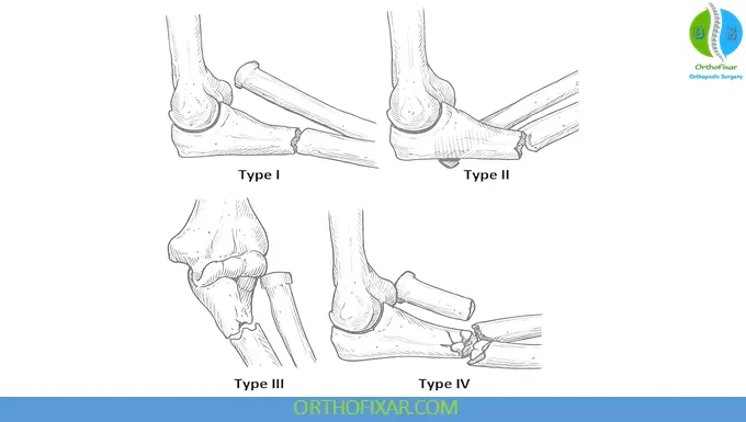 Bado-Classification-of-Monteggia Monteggia Fracture