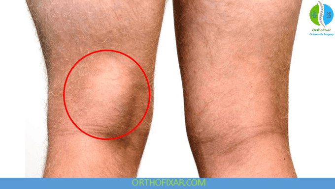 Baker Cyst Behind the Knee APPEARANCE