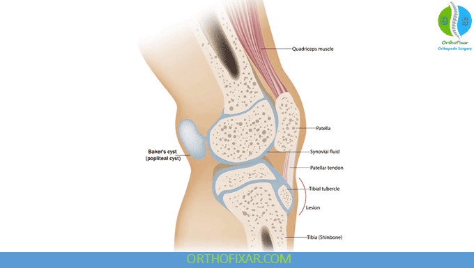 Baker Cyst Behind the Knee
