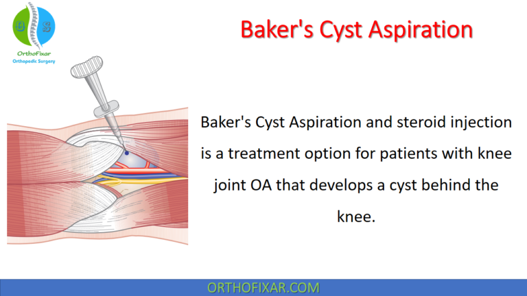 Baker's Cyst Aspiration