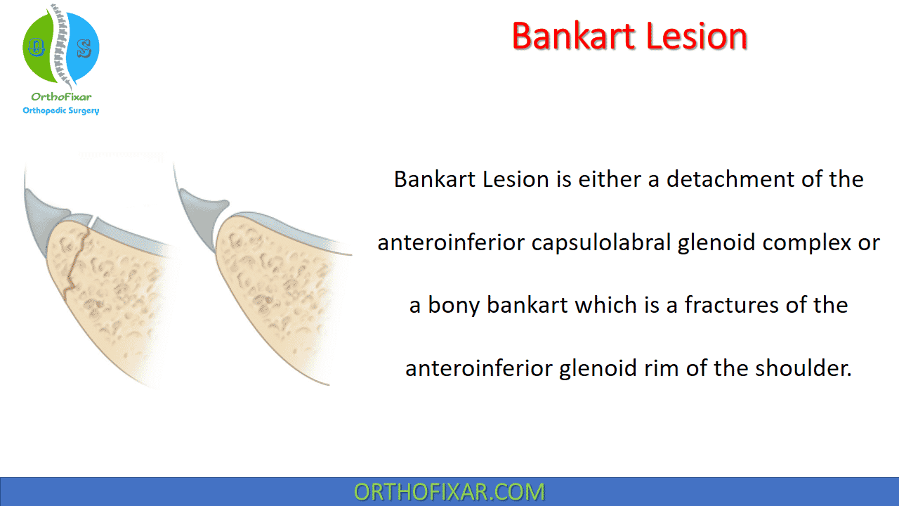 bony bankart lesion