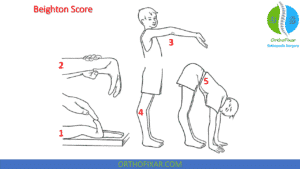 Beighton Score For Ligamentous Laxity | OrthoFixar 2024