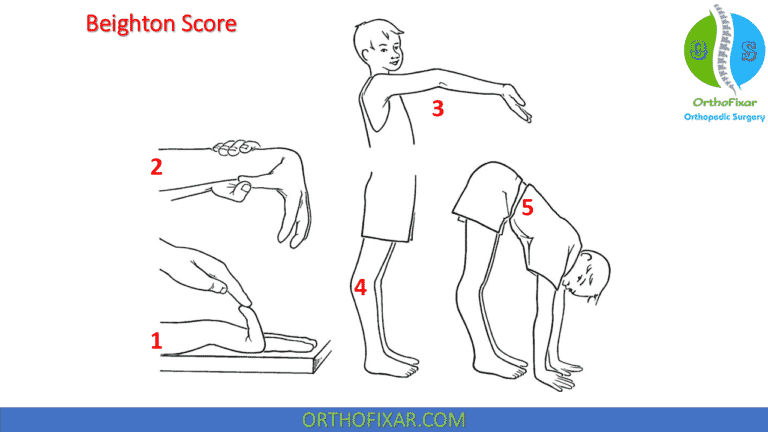 Beighton Score For Ligamentous Laxity Orthofixar 2024