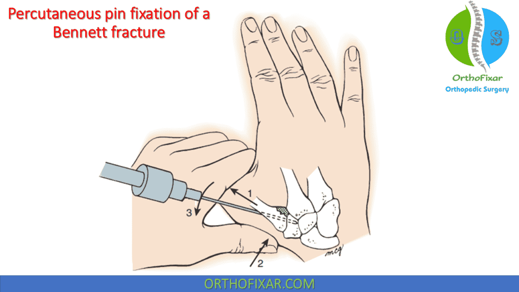 Bennett Fracture closed reduction and pinning