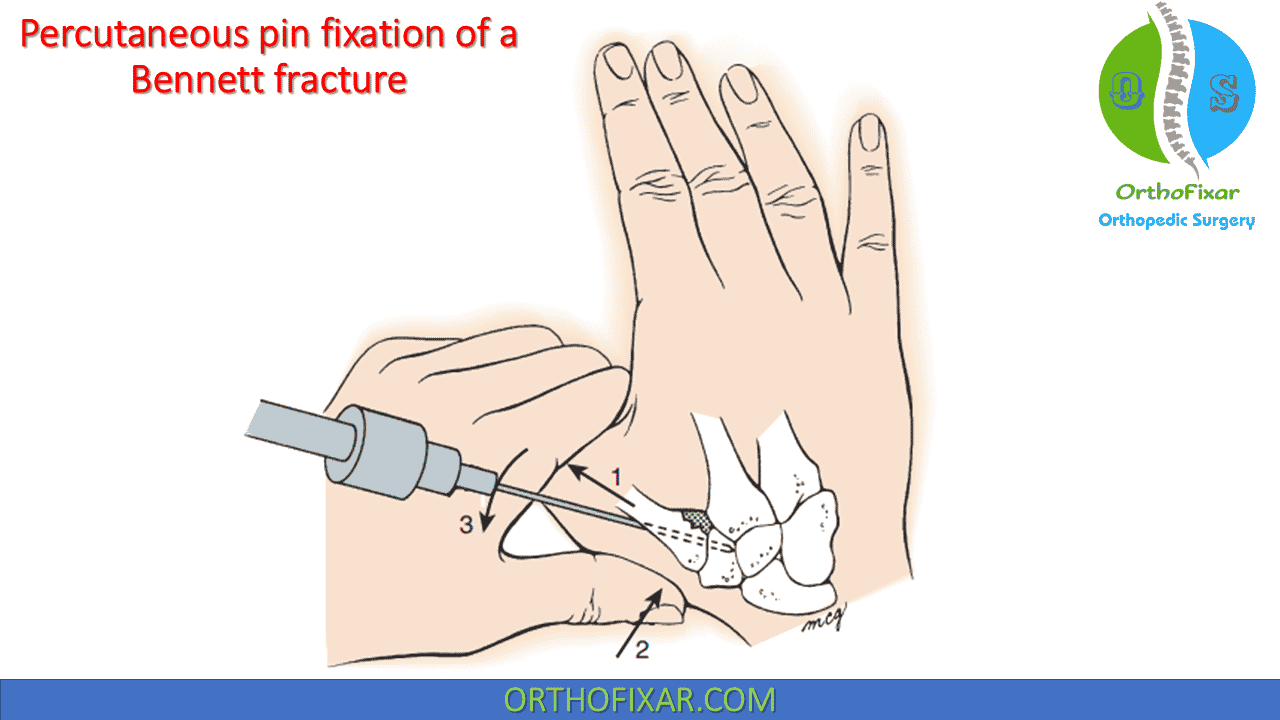 closed fracture reduction