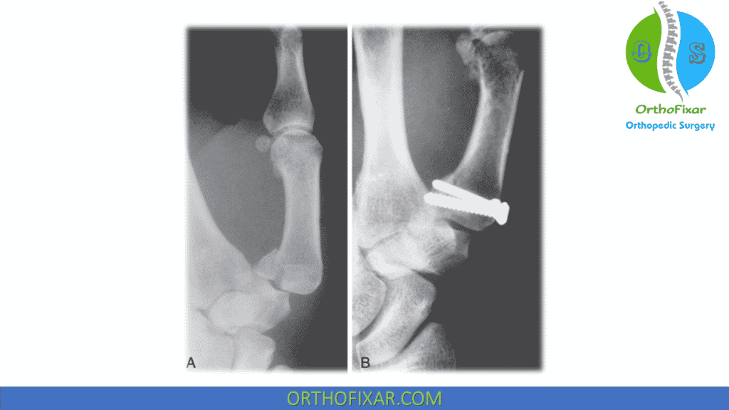 Bennett Fracture fixation with screws