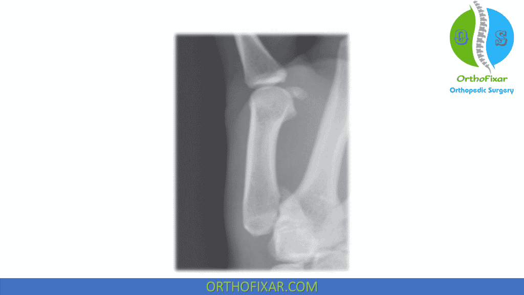 Bennett's Fracture xray