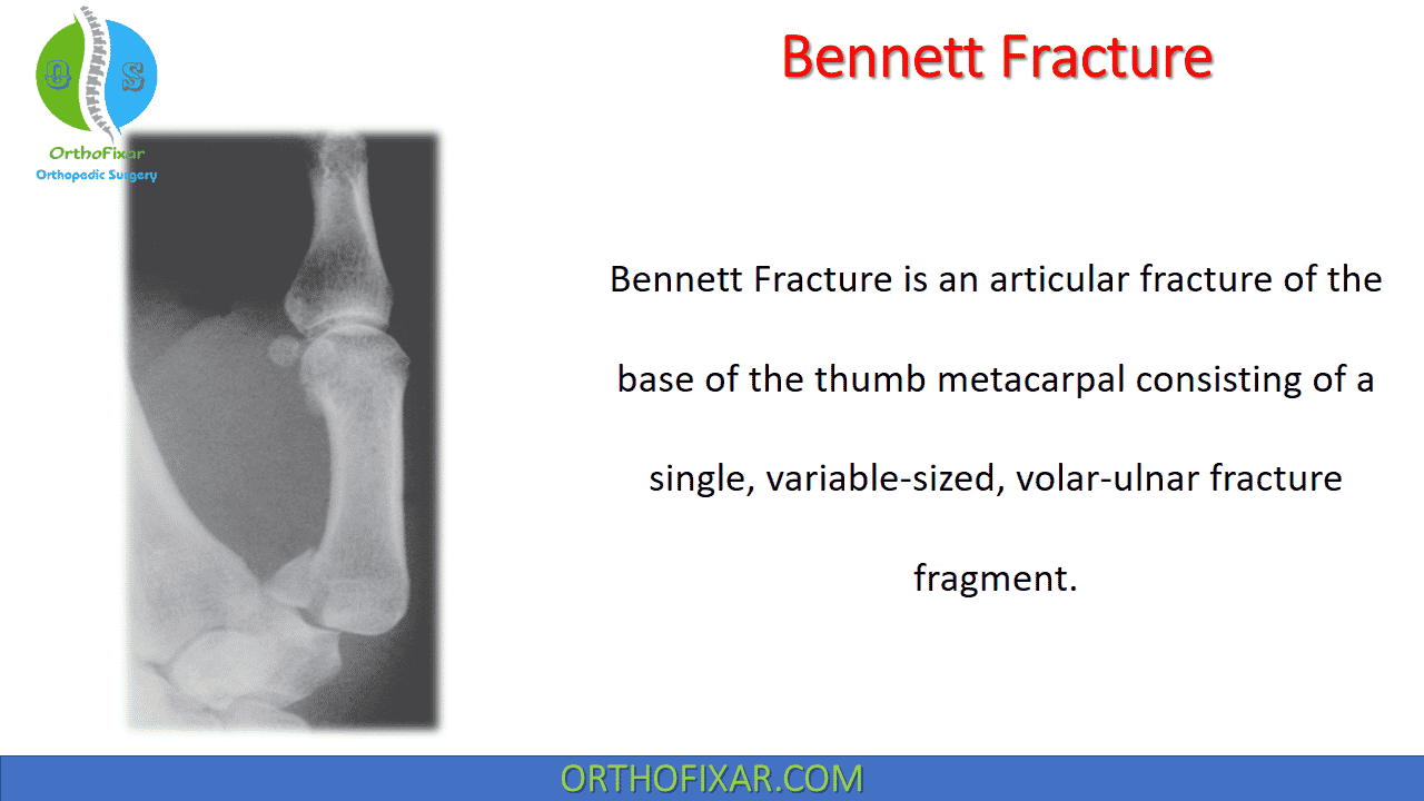  Bennett Fracture 