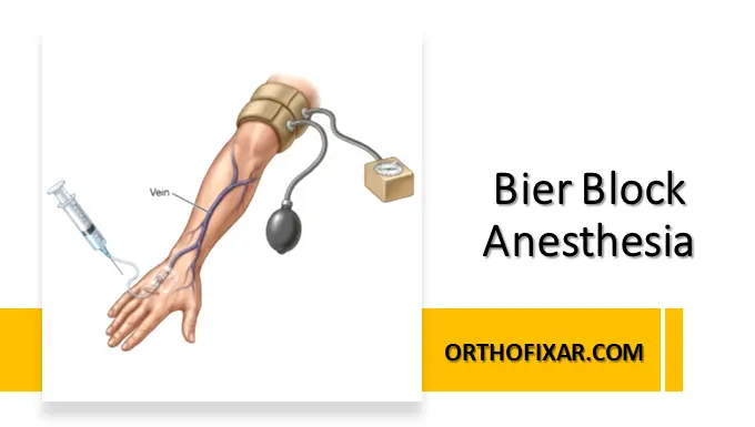 Bier Block Anesthesia
