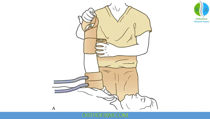 Bier Block Anesthesia (Intravenous Regional Anesthesia – IVRA) 4 Bier Block Technique 1