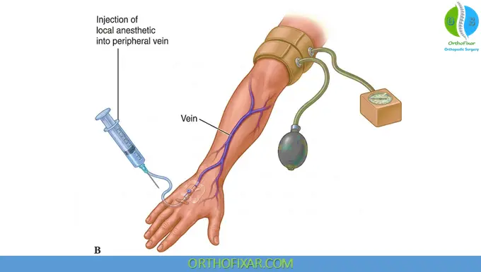 Bier Block Anesthesia (Intravenous Regional Anesthesia – IVRA) 5 Bier Block Technique 2