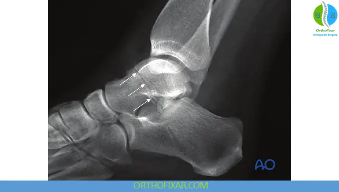 Body of Talar Fractures
