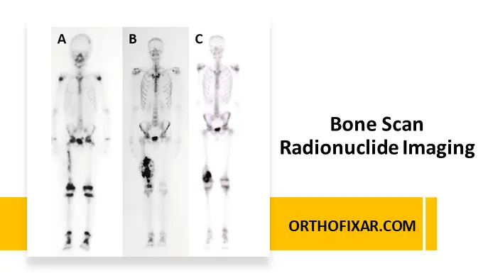 Bone Scan Radionuclide Imaging