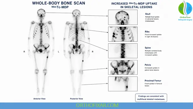 Bone Scan Radionuclide Imaging: Principles, Applications & Interpretation 6 Bone Scan Radionuclide