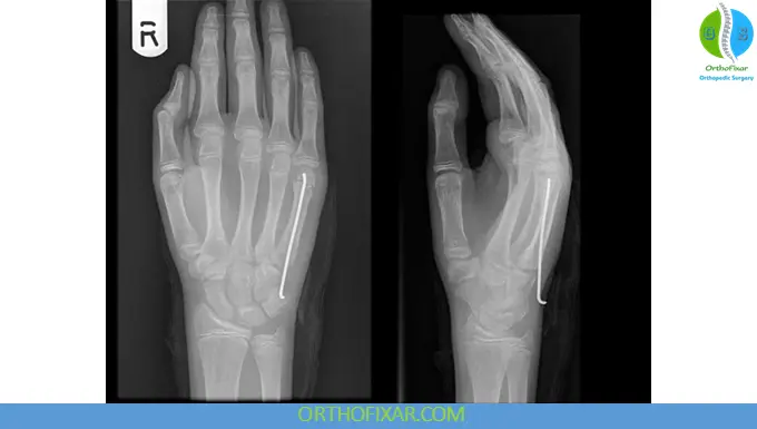 Boxer’s Fracture Treatment k-wire
