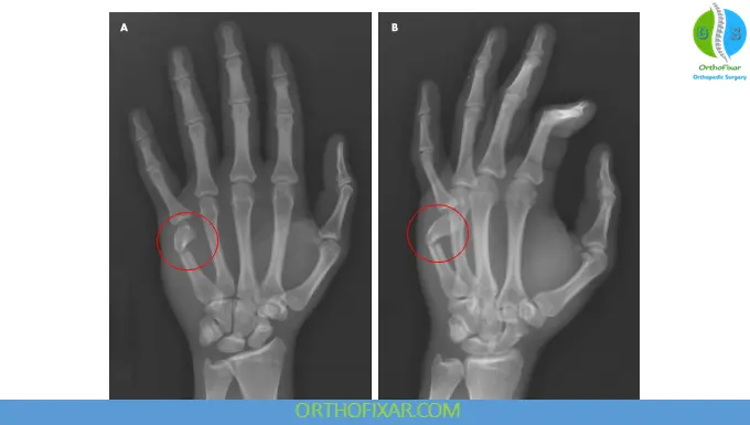 Boxer's Fracture - fracture of the neck of the fifth metacarpal - xray