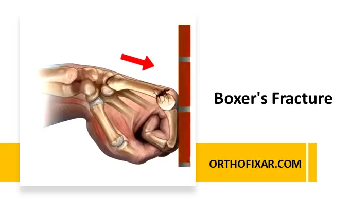 Boxer's Fracture