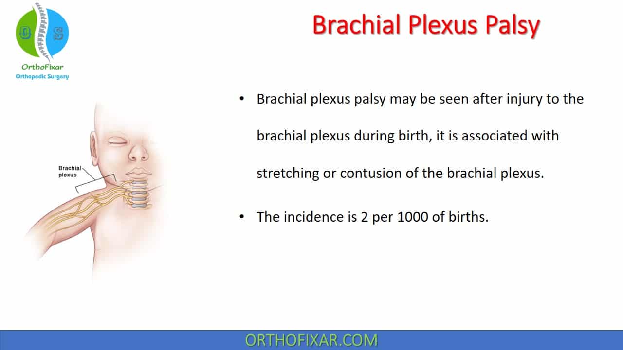  Brachial Plexus Palsy 