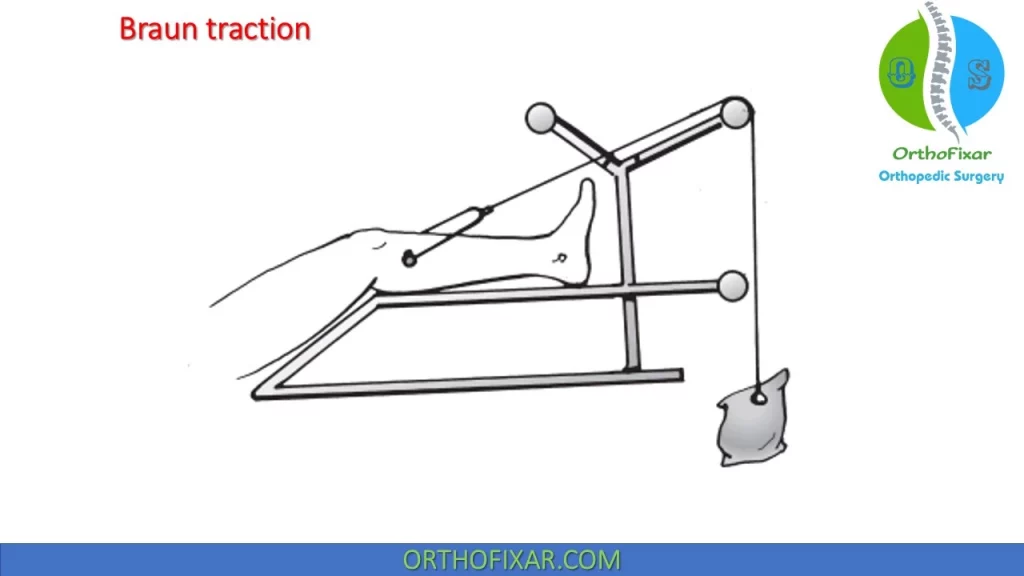 Skeletal Traction Types & Indications | OrthoFixar 2025