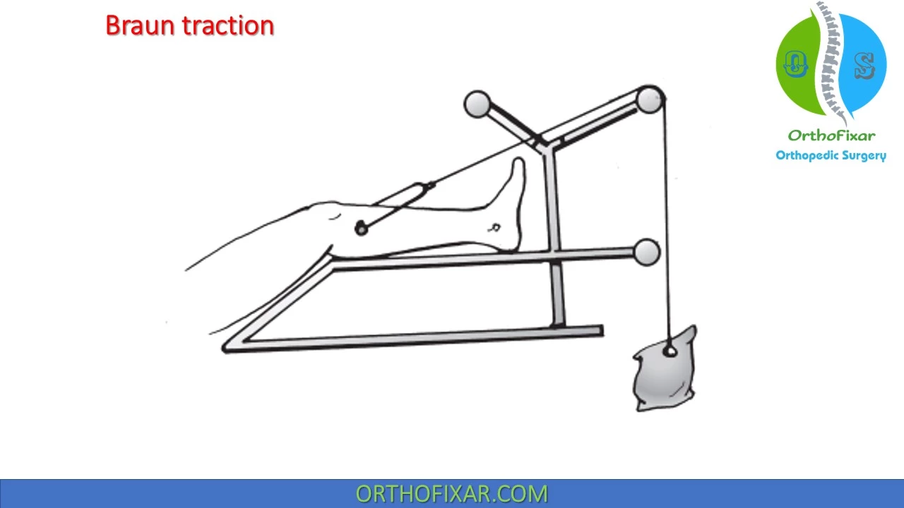 Skeletal Traction  Types, Principles & Complications - Video