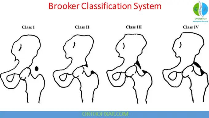 Heterotopic Ossification: Pathophysiology, Classification, Diagnosis & Treatment 8 Brooker Classification System