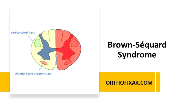 Brown-Séquard Syndrome