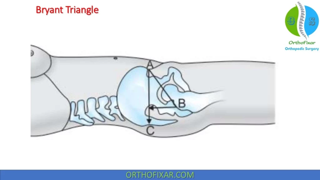 Bryant Triangle Assessing Hip Joint Geometry Bryant Triangle Assessing Hip Joint Geometry