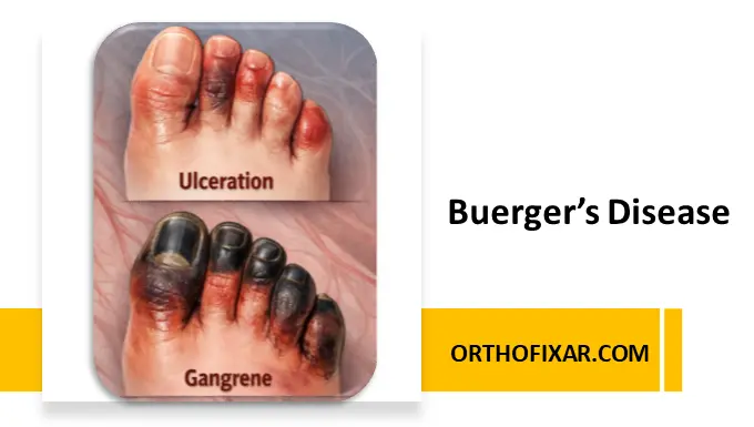 Buerger’s Disease