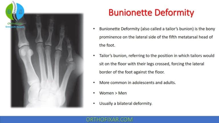 Bunionette Deformity