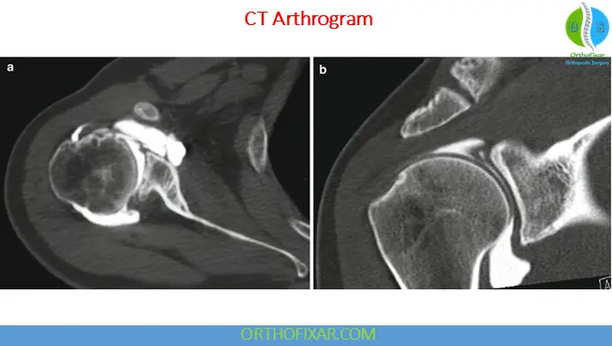 Arthrography: Indications, Technique, Uses & Interpretation 7 CT arthrogram