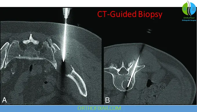 Bone Biopsy: Indications, Types, Risks & Diagnostic Accuracy 4 CT-guided Bone Biopsy