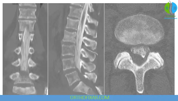 Myelography: Indications, Procedure, Interpretation & Complications 5 CT myelogram