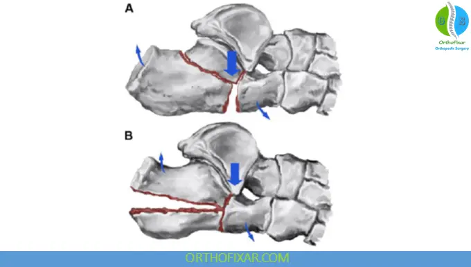 Calcaneus Fracture Essex–Lopresti Classification