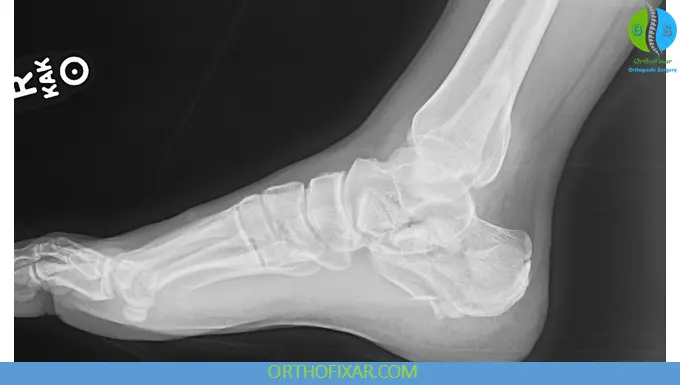 Calcaneus Fracture xray