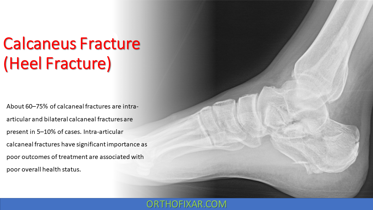 Calcaneus Fractures - Trauma - Orthobullets