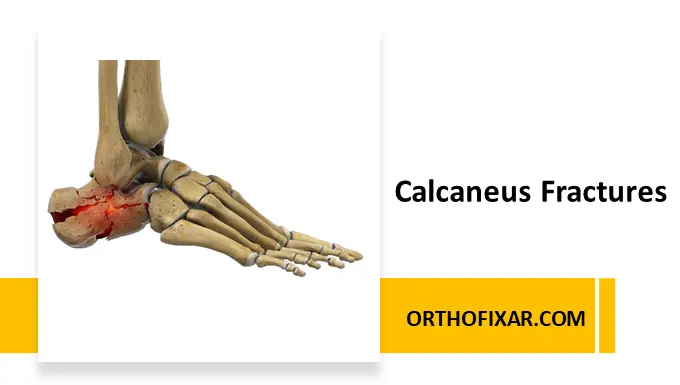 Calcaneus Fracture