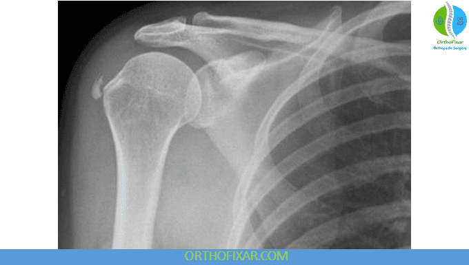 Calcific Tendonitis of the Shoulder