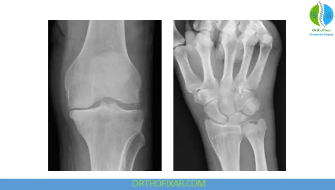 Calcium Pyrophosphate Deposition Disease - CPPD 3 Calcium Pyrophosphate Deposition Disease - CPPD xray