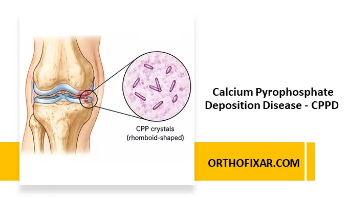 Calcium Pyrophosphate Deposition Disease - CPPD
