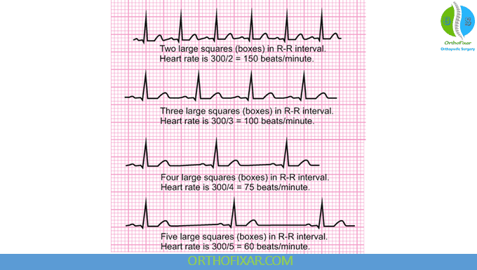 ECG Interpretation for Medical Students: Rate, Rhythm and Axis 6 Calculating the Heart Rate The 300 Method