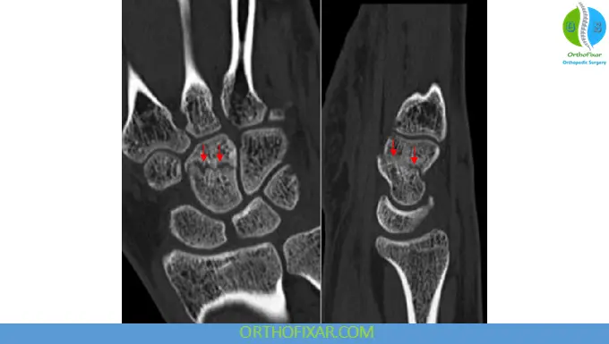 Capitate Fracture imaging